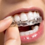 aligneur invisalign