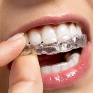 aligneur invisalign